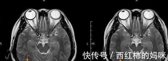 晚期|两位肺癌晚期患者，只因做好了“四件事”，生存期明显延长