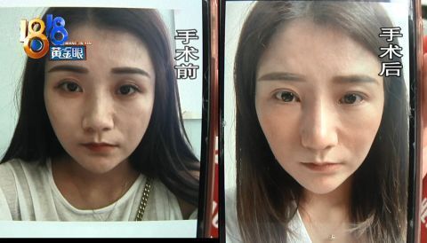 面部线雕|整容后感觉老十岁,“本来我看起来很年轻的”