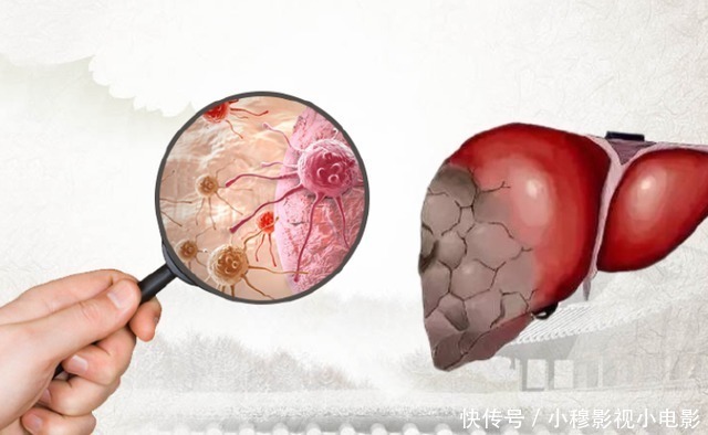 蜘蛛痣|肝变“硬”和吃面条有关?医生坦言:养肝护脏,这2种食物要远离