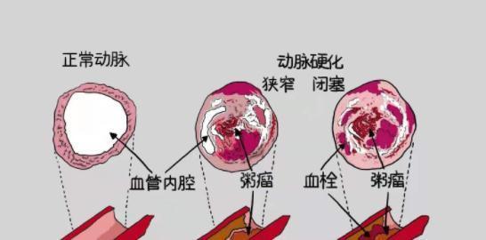 心络胶囊|冬季是冠心病患者的危险期,该注意什么?本文说清