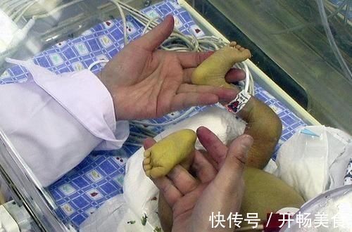 怀孕期间|新生儿有黄疸,孕期这个行为是“罪魁祸首”,有身孕的妈妈要控制