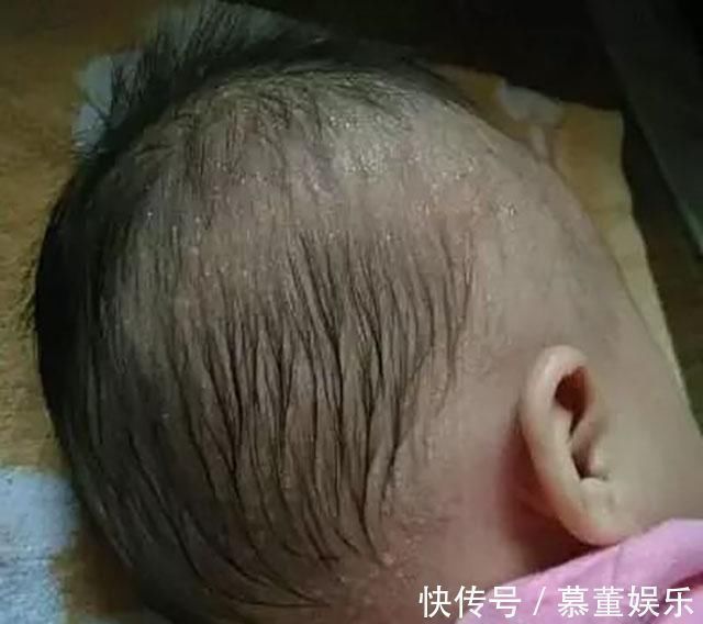 佝偻病|孩子睡觉时,若有这3个表现,多半是疾病发出的信号,妈妈要留心