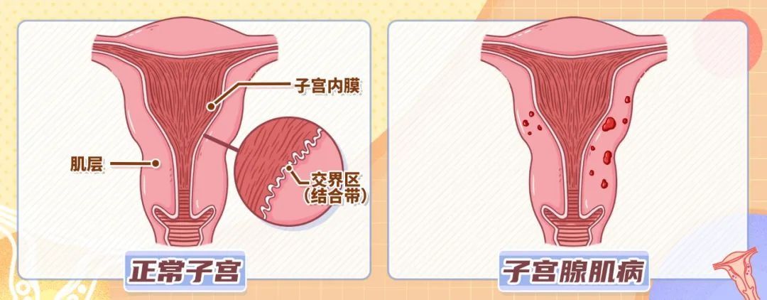 月经量|一种可能影响女性一生的疾病，痛经、不孕或许都会接踵而来