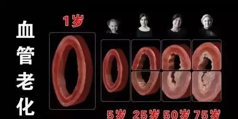血液|德国颠覆性研究：动脉硬化斑块并非来自血液中的脂肪