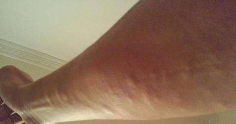 小方子|治“脂肪瘤”的小方子来了!偷学来的险招,治疙瘩不痛、不痒