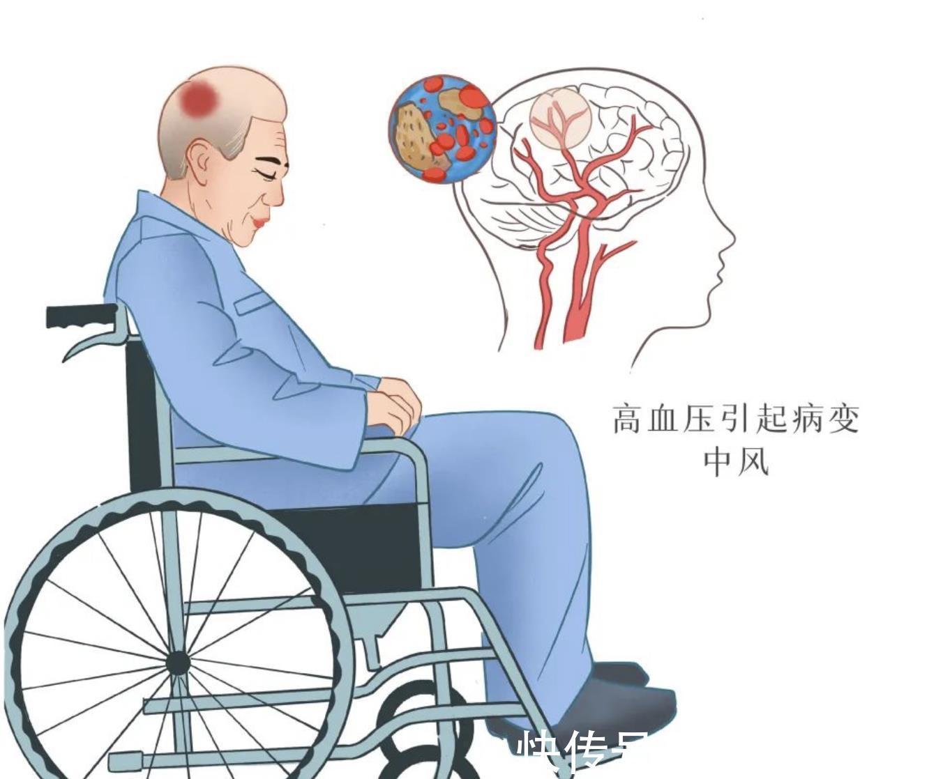 中风|哪些人群容易出现小中风呢？