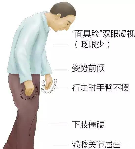 老人|走路姿势可看出60岁的人是否长寿?老年人的走路形态真重要吗?