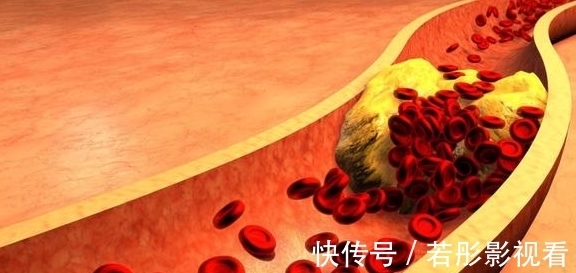 高血脂|血脂高不高，看脚就知道，若没有这4种症状，恭喜，血管还算通畅