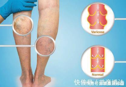 下肢|血管狭窄会有五个“标志”,超过三个以上,“暗示”血栓正在形成