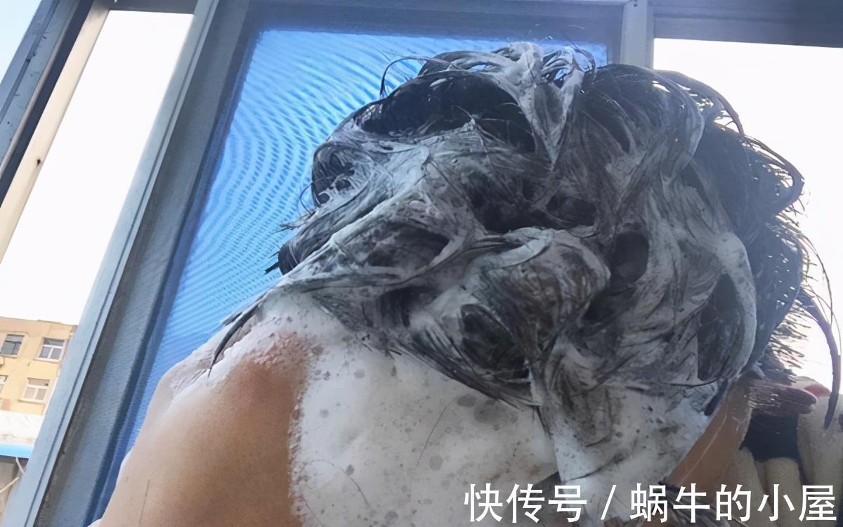 油脂|大把大把的头皮屑,是什么原因?如何才能去除?医生告诉你