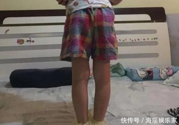 部位|孩子这三个部位“短”,将来可能不会高,希望你的孩子一个都没中