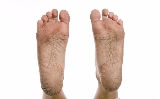 现干裂的情况|入冬后,脚后跟“干裂”?可能与3个“原因”有关