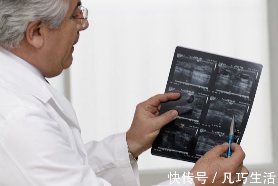 王老|肿瘤医生患癌，坚持不化疗，靠“土方法”带癌十年