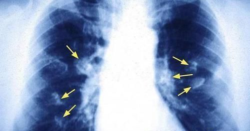 就诊|肺癌早期也是有迹可循的，身体出现这5个异常，还请及时就诊检查！