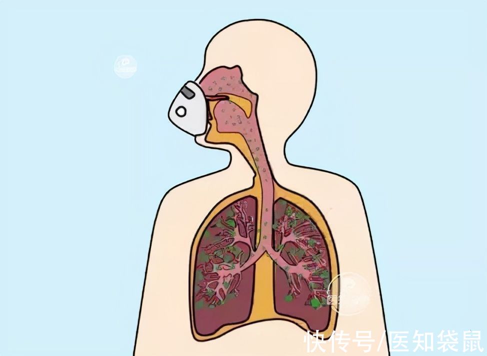 支气管炎|关于雾化，家长关心的4个问题都在这儿