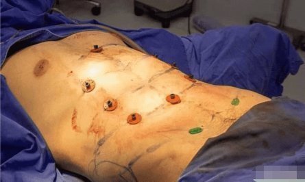 手术|24岁小哥花26000通过手术雕出6块腹肌，恢复后像填充棉絮的布偶