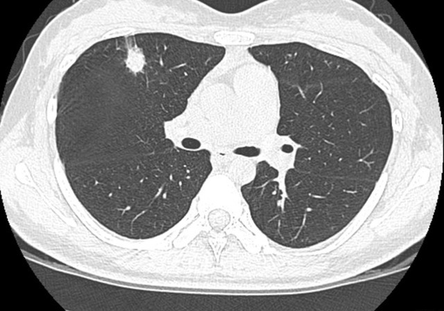 黄芪水|51岁大叔，坚持喝4年黄芪水养肺，如今肺结节好了吗