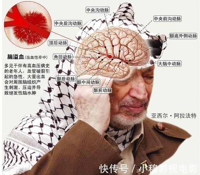 真兇|終于發現腦梗真兇，醫生稱：大腦最怕4樣東西，糾正一個都增壽！
