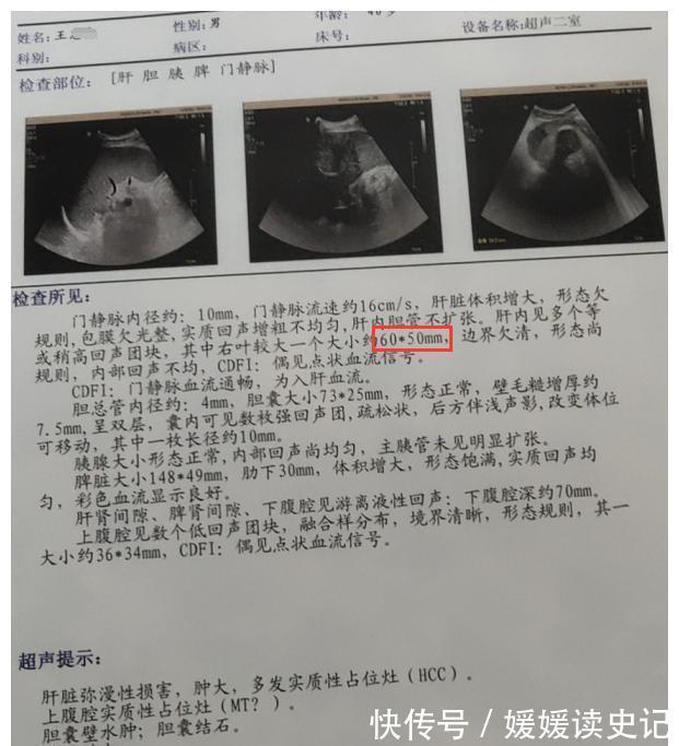 治疗|多方治疗无果的患者,加入中药后,肿瘤缩小一半