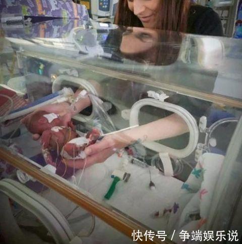 双胞胎|世界最小的双胞胎男孩，怀孕23周出生，只有手掌大小却奇迹存活