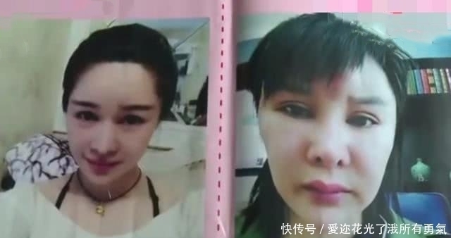 整容的代价：女子花27万却越整越丑，假胸挨着锁骨，笑起来瘆人