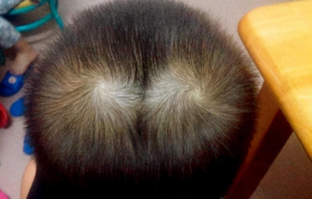 为什么有的孩子头上有2个旋?代表什么