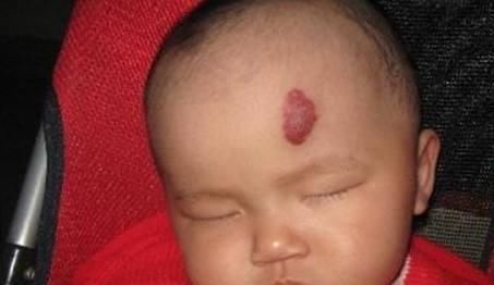 生长发育|孕期,孕妈不注意这4件事,可能宝宝出生脸上有胎记,影响颜值