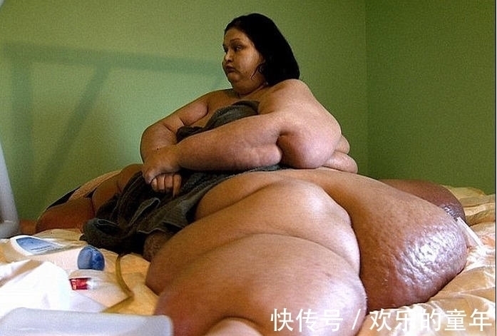 手术|1088斤胖女子经历2次手术，成功减掉648斤肥肉，堪称奇迹