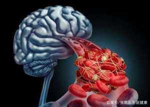  悲剧|手脚出现4种情况，高血脂需要高度警惕脑梗，细心点避免悲剧发生