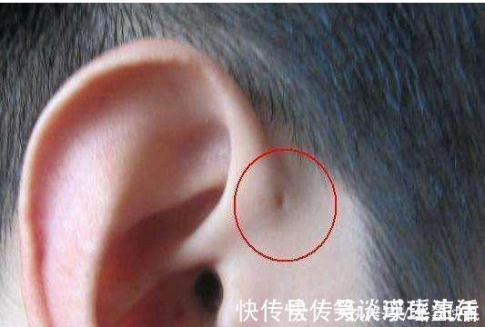 耳朵|儿子的耳朵上有个小洞宝妈试图挤压,导致孩子昏迷,被送到医院