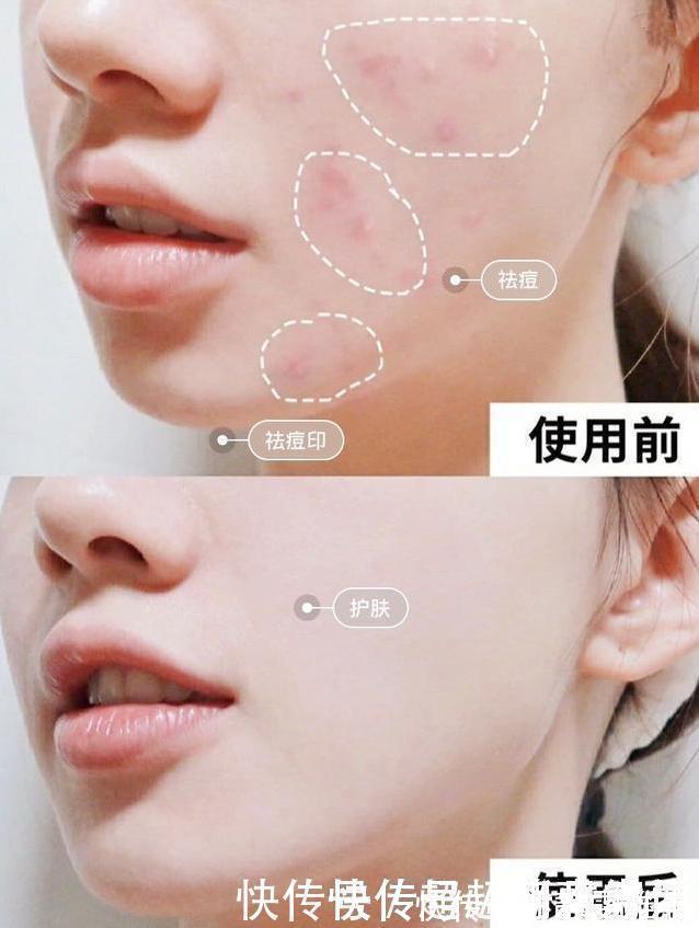 马迷|爱长“闭口粉刺”的女生,每天坚持做这件事,皮肤白白净净又细腻