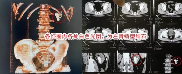 肾结石|男子患肾结石多年不痛不管，如今长成“大生姜”填满整个肾脏