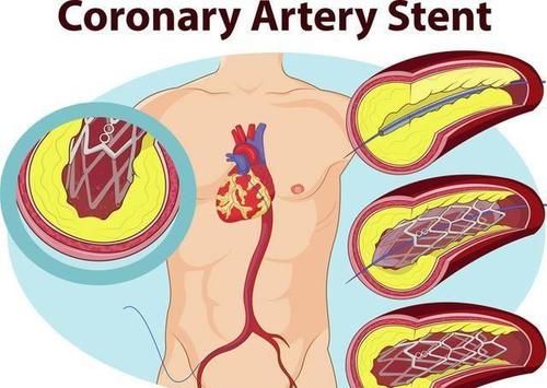 部位|血管有没有堵塞,看身体哪个部位就能知道?心血管医生告诉你