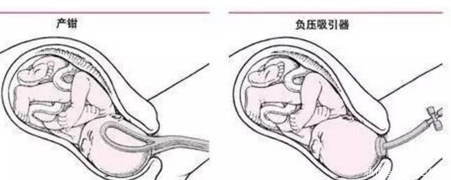 准妈妈|顺产时不顺利的会有哪一些措施，各位准妈妈们了解多少