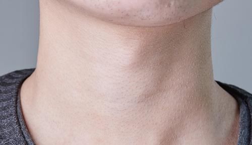 手术治疗|喉癌来之前，身体早就发出“预警”，只是多数人，都没格外留意