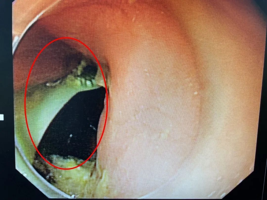 吕锋|惊呆!女子刷完牙漱口,整支牙刷竟掉进胃里