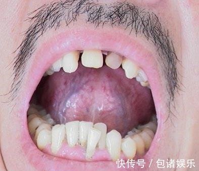 癌症|身体里有肿瘤,舌头上也会有表现!出现3种异象需小心