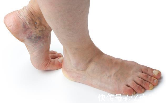 静脉|体内有血栓，脚知道脚上若有4种反应，小心血管随时爆发