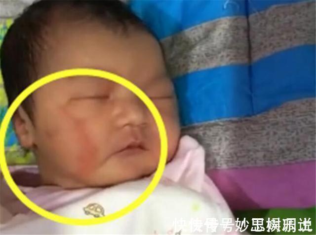 产钳|宝宝出生3个月,脸上“产钳印”明显,儿媳遭婆婆责备“没本事”