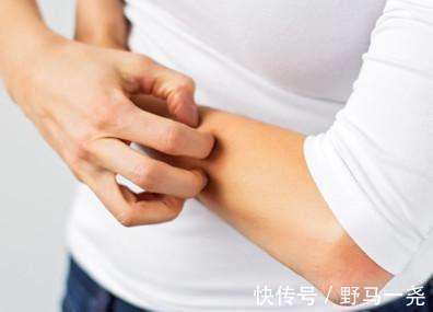 灼热感|皮肤出现3个信号,警惕糖尿病“恶化”!做好2点,远离并发症