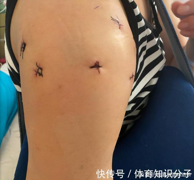 冈上肌|泪目！女排奥运冠军右肩手术：多处撕裂打8枚钢钉！网友：心疼你