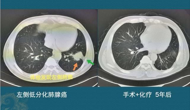 癌症|查出癌症不放疗不化疗，保持良好心态吃喝玩乐，能扛过去吗