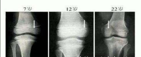 骨线|孩子出现3个信号,是''骨线闭合''的前兆,宝妈早发现还能补救