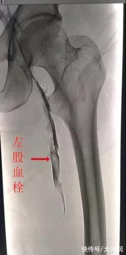 滤器|河南男子腿静脉血栓危及生命 医生：久坐不动是下肢深静脉血栓诱因之一