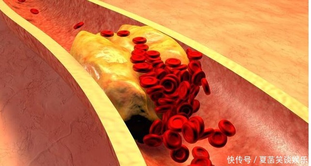 血脂升高|血脂高不高,看头就知道,若没有4种症状,恭喜,血管还算通畅