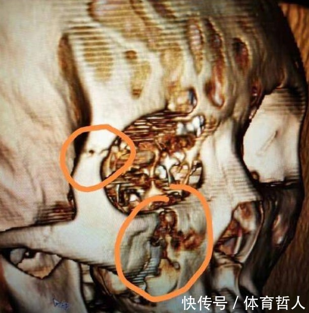 骨折|CBA官宣!广厦队悍将造成了廖三宁面部骨折,罚款10万+停赛3场