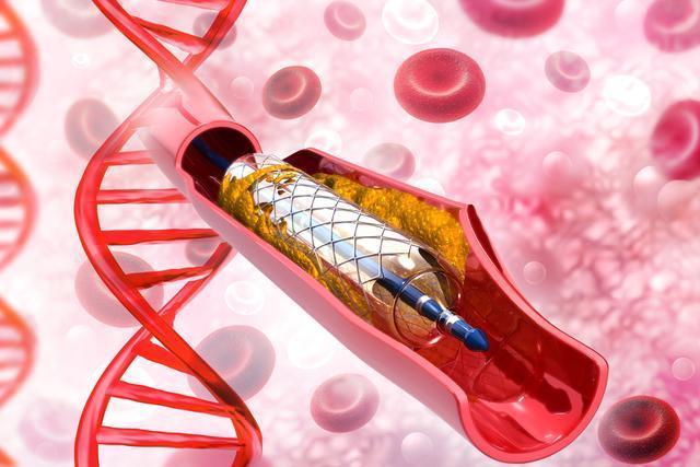 吃药|同是冠心病,一个长期吃药一个放了支架,十年后命运截然不同