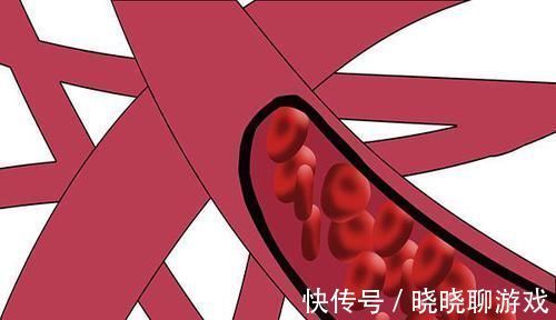血管|斑块多,血管堵,如何清理血管,预防堵塞小妙招不妨学一学