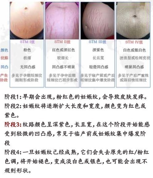 孕妇|什么时候开始预防妊娠纹?八成以上的孕妇都做错了!后悔就晚了!