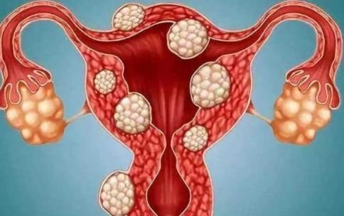 女人们|女人为何会患上子宫肌瘤呢?有4个原因,女人们心里要清楚!